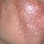 How to Remove Melasma