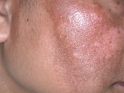 How to Remove Melasma