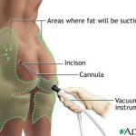 How to Maintain Liposuction Results