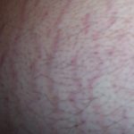 Stretch Mark Repair