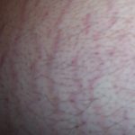 Stretch Mark Repair