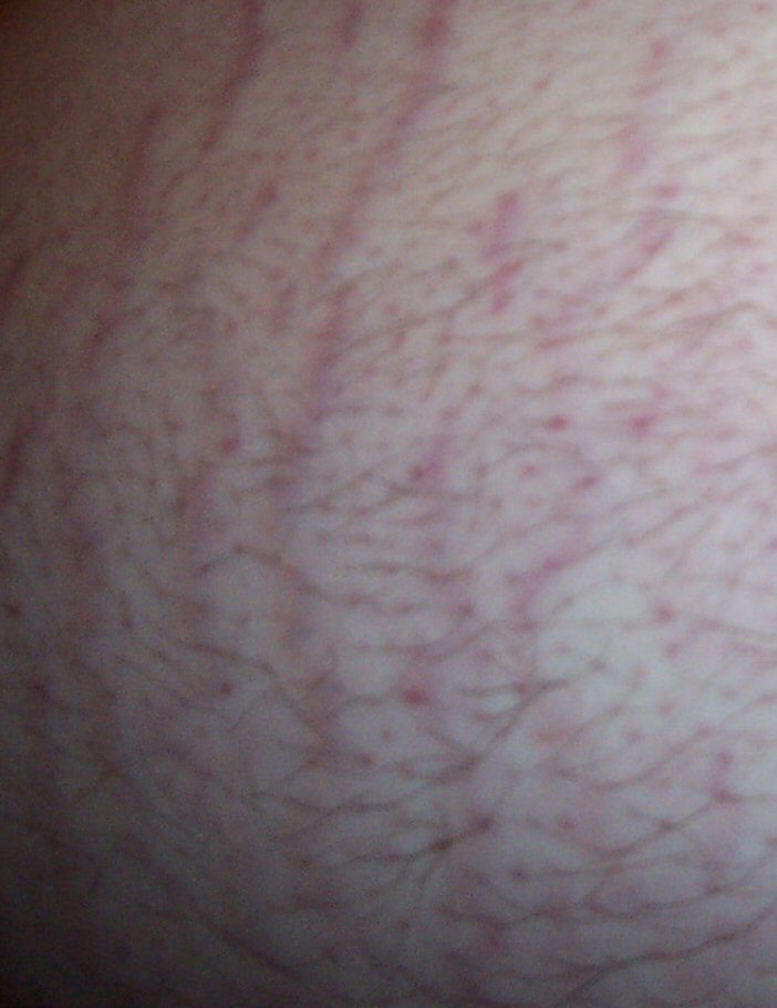 Stretch Mark Repair